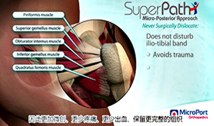 SuperPATH<sup>?</sup>, SuperCap<sup>?</sup>, Path<sup>?</sup>手术入路